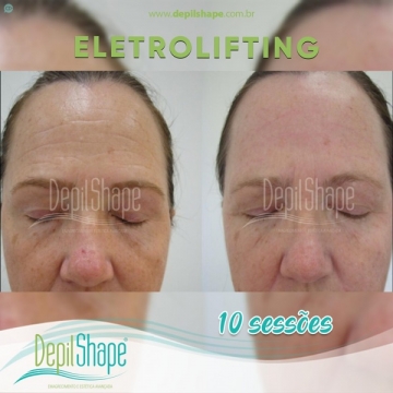 Eletrolifting