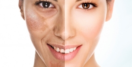Melasma